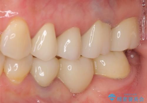 金属を全てセラミックに メタルフリー治療の治療後