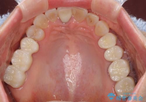 金属を全てセラミックに メタルフリー治療の治療後