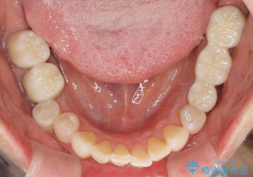 金属を全てセラミックに メタルフリー治療の治療後
