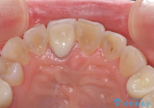 金属を全てセラミックに メタルフリー治療の治療後