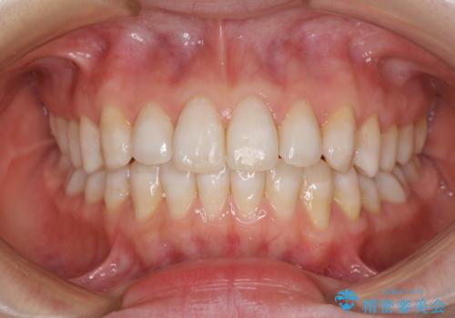 話しにくいオープンバイト インビザラインによる矯正治療の症例 治療後
