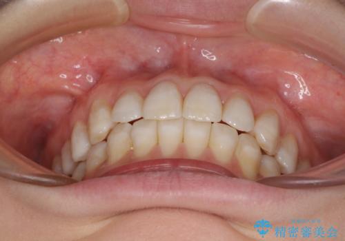 話しにくいオープンバイト インビザラインによる矯正治療の治療後