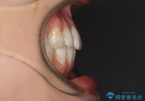 話しにくいオープンバイト インビザラインによる矯正治療の治療後