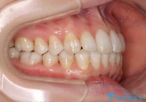 話しにくいオープンバイト インビザラインによる矯正治療の治療後
