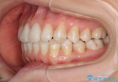 話しにくいオープンバイト インビザラインによる矯正治療の治療後