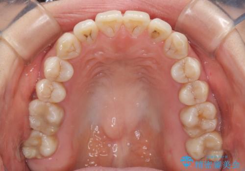 話しにくいオープンバイト インビザラインによる矯正治療の治療後