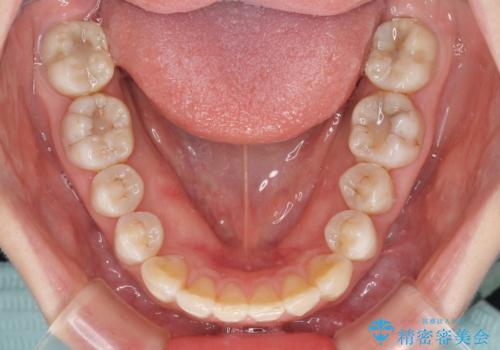 話しにくいオープンバイト インビザラインによる矯正治療の治療後
