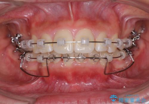 口が閉じられない 抜歯矯正で口元をスッキリとの治療中