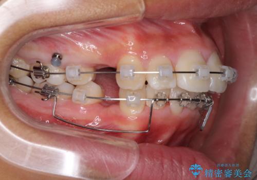 口が閉じられない 抜歯矯正で口元をスッキリとの治療中