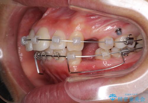 口が閉じられない 抜歯矯正で口元をスッキリとの治療中