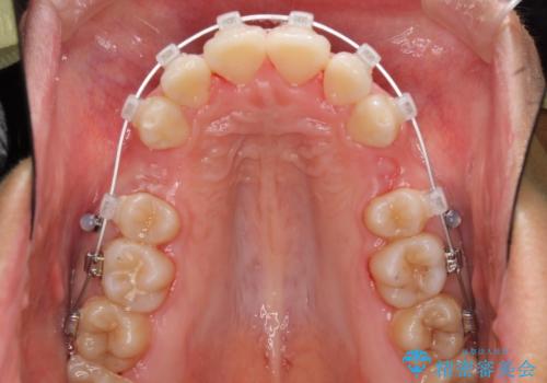 口が閉じられない 抜歯矯正で口元をスッキリとの治療中
