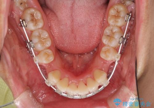 口が閉じられない 抜歯矯正で口元をスッキリとの治療中