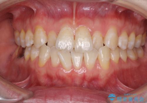 前歯のデコボコを治したい インビザラインによる矯正治療の症例 治療前