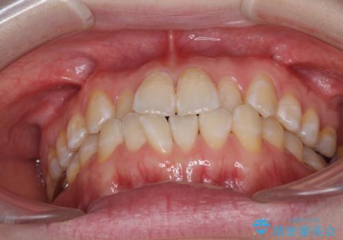 前歯のデコボコを治したい インビザラインによる矯正治療の治療前