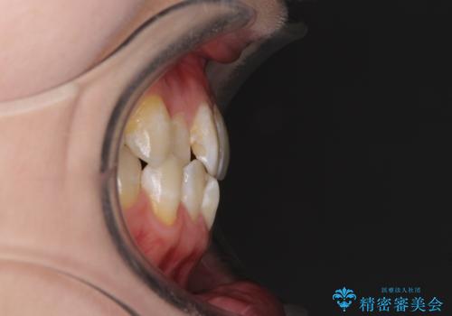 前歯のデコボコを治したい インビザラインによる矯正治療の治療前