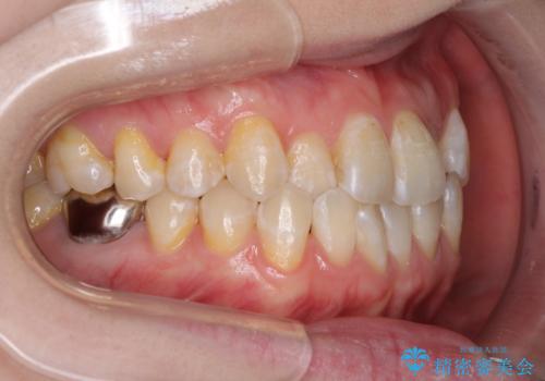 前歯のデコボコを治したい インビザラインによる矯正治療の治療前