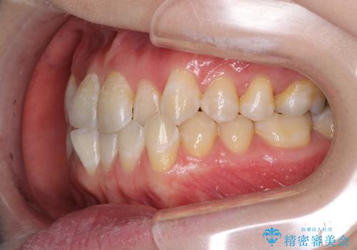 前歯のデコボコを治したい インビザラインによる矯正治療の治療前