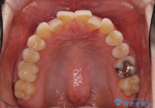 前歯のデコボコを治したい インビザラインによる矯正治療の治療前