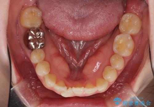 前歯のデコボコを治したい インビザラインによる矯正治療の治療前