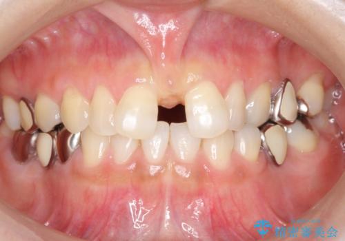 大人の上唇小帯切除 前歯のすき間の原因になりますの治療前