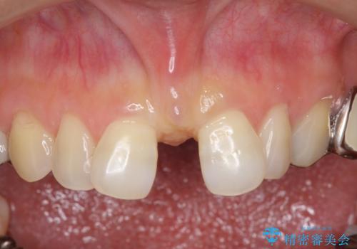 大人の上唇小帯切除　前歯のすき間の原因になりますの治療前