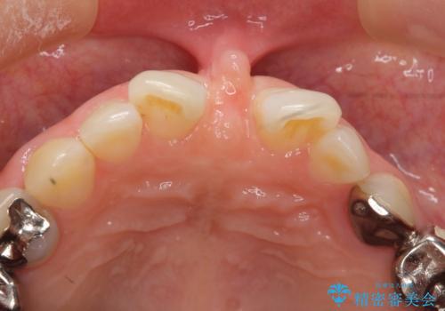 大人の上唇小帯切除 前歯のすき間の原因になりますの治療前