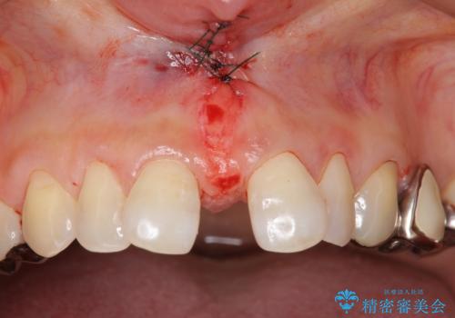 大人の上唇小帯切除　前歯のすき間の原因になりますの治療中