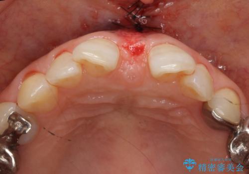大人の上唇小帯切除 前歯のすき間の原因になりますの治療中