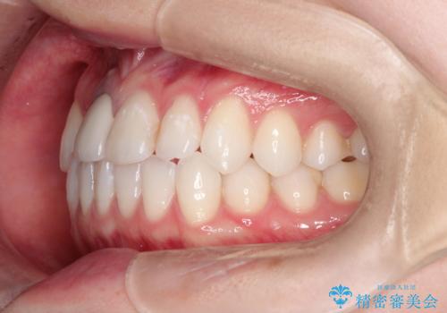 インビザライン 自信をもって笑えるようになりました。の治療前