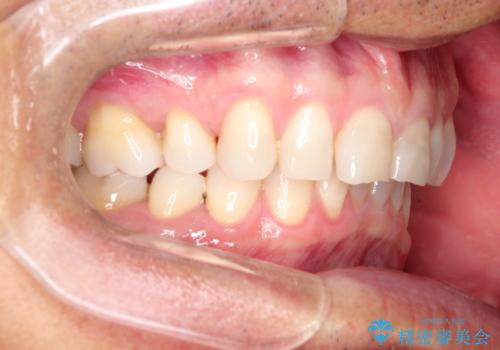 上の前歯の隙間とがたつきをインビザラインできれいな歯並びへの治療前