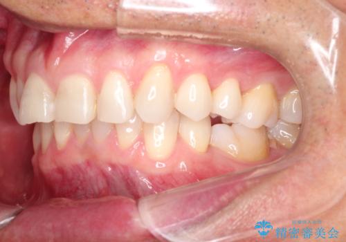 上の前歯の隙間とがたつきをインビザラインできれいな歯並びへの治療前