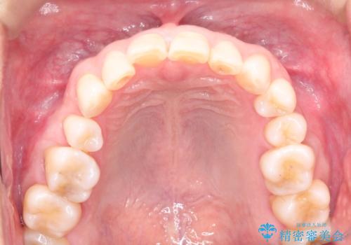 上の前歯の隙間とがたつきをインビザラインできれいな歯並びへの治療前