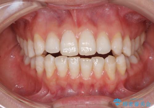 話しにくいオープンバイト インビザラインによる矯正治療の症例 治療前