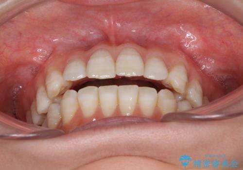 話しにくいオープンバイト インビザラインによる矯正治療の治療前