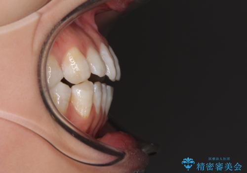 話しにくいオープンバイト インビザラインによる矯正治療の治療前