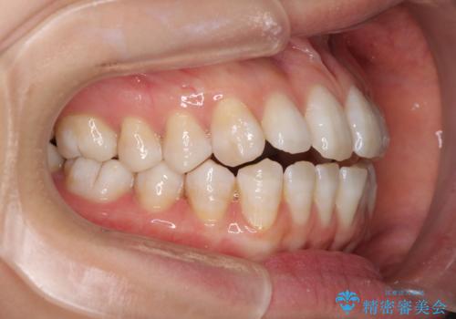 話しにくいオープンバイト インビザラインによる矯正治療の治療前