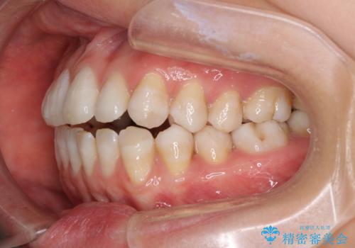 話しにくいオープンバイト インビザラインによる矯正治療の治療前
