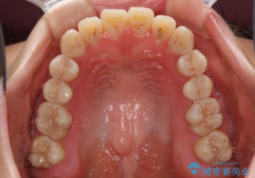 話しにくいオープンバイト インビザラインによる矯正治療の治療前