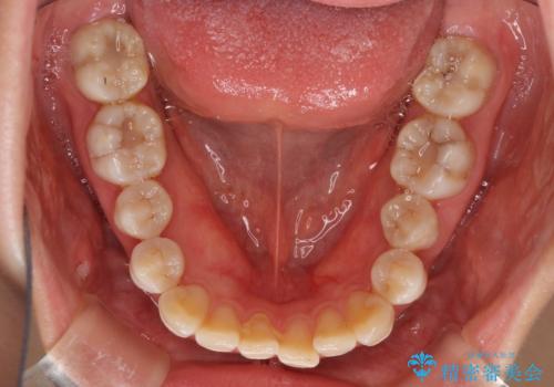 話しにくいオープンバイト インビザラインによる矯正治療の治療前
