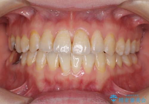 前歯のデコボコを治したい インビザラインによる矯正治療の治療中