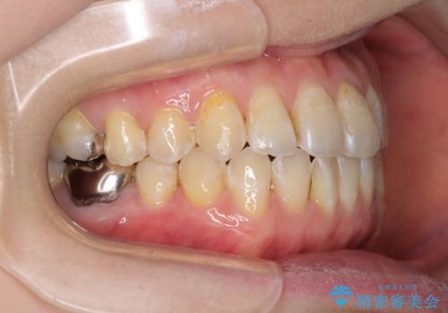 前歯のデコボコを治したい インビザラインによる矯正治療の治療中