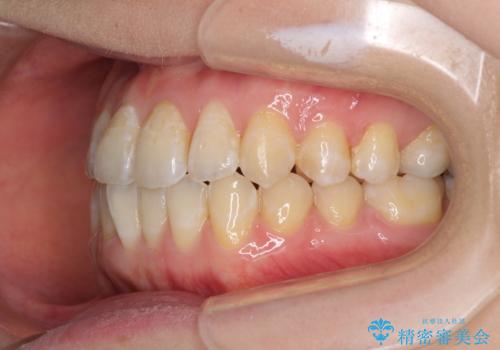 前歯のデコボコを治したい インビザラインによる矯正治療の治療中