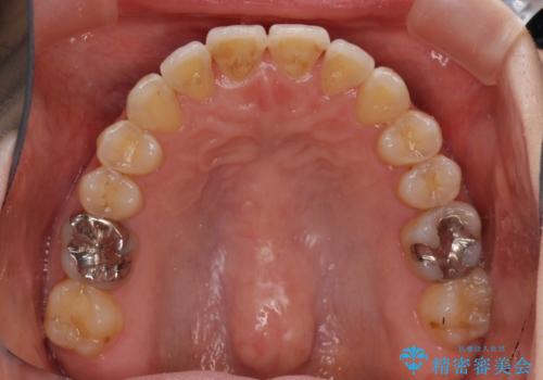 前歯のデコボコを治したい インビザラインによる矯正治療の治療中