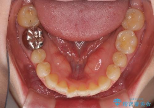 前歯のデコボコを治したい インビザラインによる矯正治療の治療中
