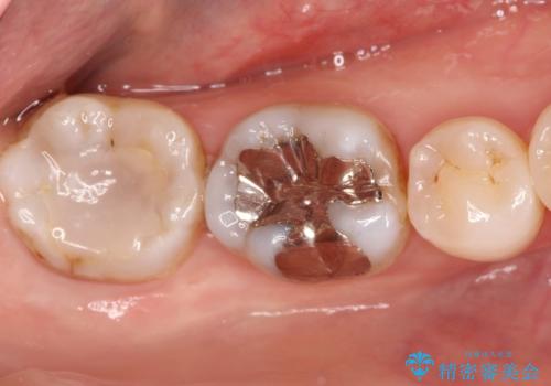 メタルフリー セラミックインレーによる治療の治療前