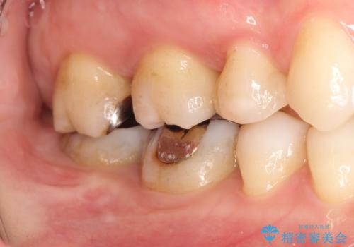 メタルフリー セラミックインレーによる治療の治療前