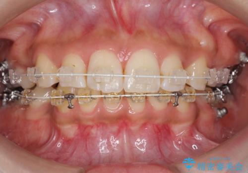 Eラインを整える治療 前歯を引っ込めますの治療中