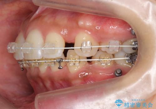 Eラインを整える治療 前歯を引っ込めますの治療中