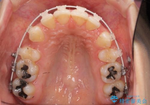 Eラインを整える治療 前歯を引っ込めますの治療中