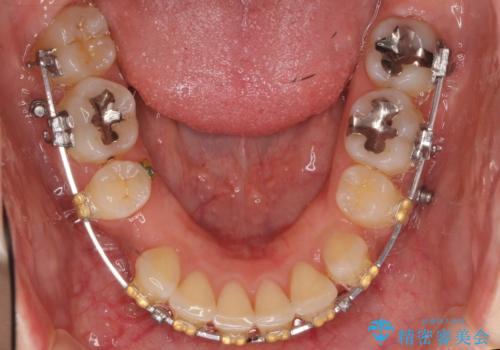 Eラインを整える治療 前歯を引っ込めますの治療中